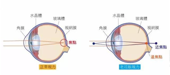 500度近視又老花，戴上美麗島多焦鏡煩惱全解決，46歲的周先生樂壞了