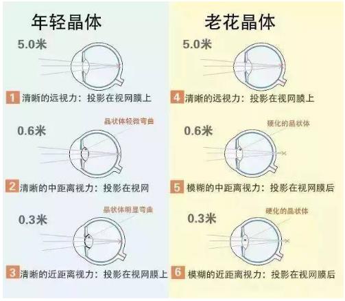 近視就不會(huì)老花了嗎？